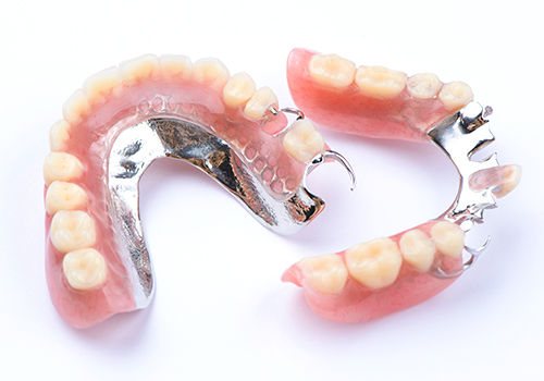 自由診療の部分入れ歯：金属床
